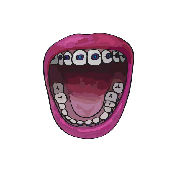 Frenos dentales en boca abierta. Estilo de dibujos animados — Vector de stock