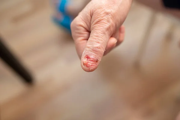 Felon whitlow on finger toe injured to lose nail — Stock Photo, Image