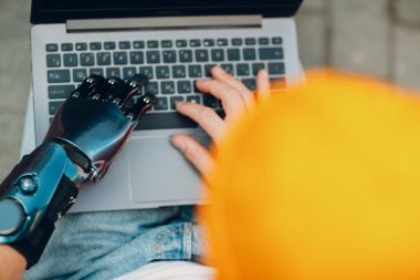 Dizüstü bilgisayar klavyesinde daktilo kullanan yapay eli olan engelli genç bir adam..