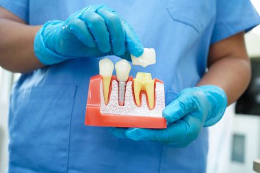 Doktor diş implantı, çeneye yapay diş kökleri, diş tedavisinin kök kanalı, diş eti hastalığı, diş hekimliği üzerine çalışan dişçi modeli.