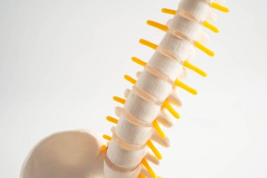 Omurga ve kemik, bel kemiği yerinden oynamış disk parçası, ortopedi bölümünde tedavi için model..