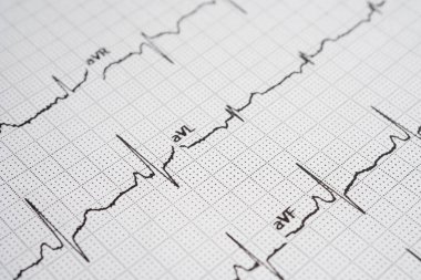 Elektrokardiyogram (EKG), kalp dalgası, kalp krizi, kardiyogram raporu.