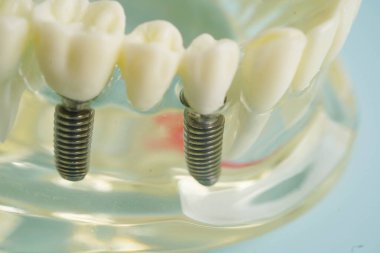 Diş hekimliği hakkında bilgi almak için beyaz arkaplanda diş modeli.