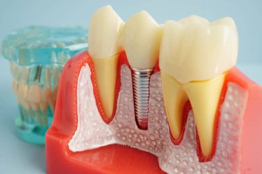 Diş implantı, çeneye yapay diş kökleri, diş tedavisinin kök kanalı, diş eti hastalığı, diş hekimliği üzerine çalışan dişçi modeli.