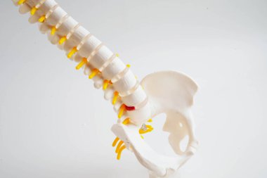 Omurga ve kemik, bel kemiği yerinden oynamış disk parçası, ortopedi bölümünde tedavi için model..