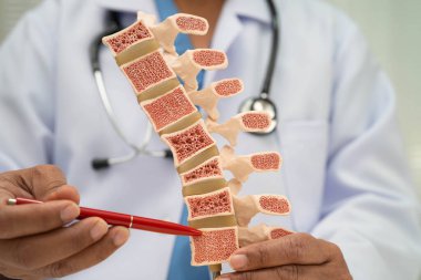 Doktor, ortopedi bölümünde tedavi için kemik modelinde osteoporoz tutuyor..