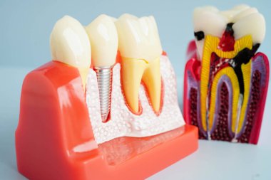Diş implantı, çeneye yapay diş kökleri, diş tedavisinin kök kanalı, diş eti hastalığı, diş hekimliği üzerine çalışan dişçi modeli.