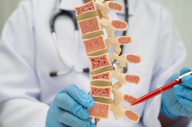 Doktor, ortopedi bölümünde tedavi için kemik modelinde osteoporoz tutuyor..