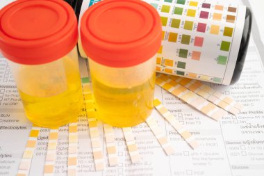 İdrar tahlili, reaksiyonlu idrar kabı. PH kağıt testi ve karşılaştırma tablosu laboratuvarda..