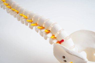 Omurga ve kemik, bel kemiği yerinden oynamış disk parçası, ortopedi bölümünde tedavi için model..