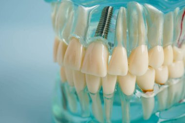 Diş implantı, çeneye yapay diş kökleri, diş tedavisinin kök kanalı, diş eti hastalığı, diş hekimliği üzerine çalışan dişçi modeli.