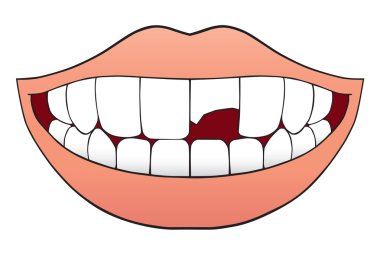 Broken tooth in smiling mouth clipart