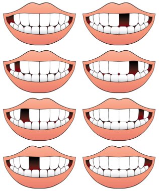 Missing tooth series clipart