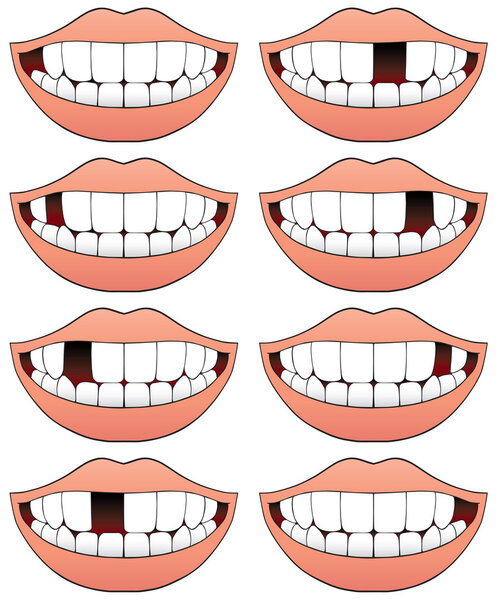 Missing tooth series