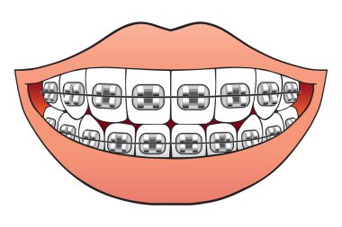 Teeth With Braces clipart