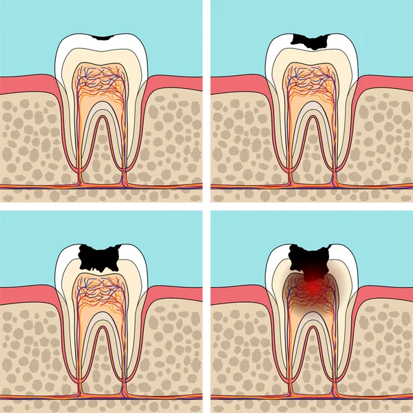 Stades de caries dentaires . — Image vectorielle