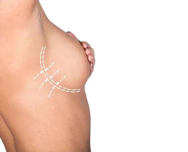 plastik veya kozmetik cerrahi, selülit düzeltme, insanlar ve welness kavramı. kadın büstü hatları ile. Göğüs büyütme