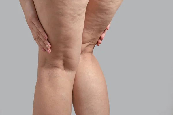 Растяжки, целлюлит и варикозное расширение вен на женских ногах. Copyspace — стоковое фото