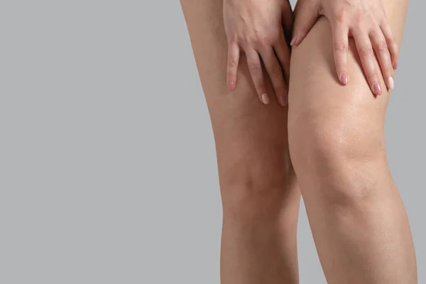 Stretch marks, cellulite and varicose veins on female legs. Copyspace — Stock Photo, Image