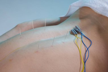 İğneler ve elektrot ile elektroakupunktur yakın görüş güvenli ağrı kesici ve rehabilitasyon için omurga boyunca yol açar.