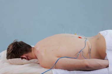 Elektroakupunktur sırasında, güvenli ağrı kesici ve rehabilitasyon için omurga boyunca steril iğnelere bağlanan kablolar gibi yatkın hastalar..