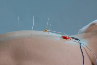 Sırtındaki elektroakupunktur sırasında kurşunlara bağlı steril iğneleri kapatın. Güvenli ağrı kesici ve rehabilitasyon için kullanılır..