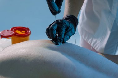 Ağrı kesici ve iyileşme için yapılan akupunktur terapisi sırasında sırtındaki steril iğneye yakından bak..