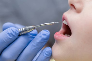 Pediatrik diş bakımı sırasında kesici diş yanında gingiva tedavisi yapan diyot lazeri steril ve nazik bir tekniği vurguluyor.