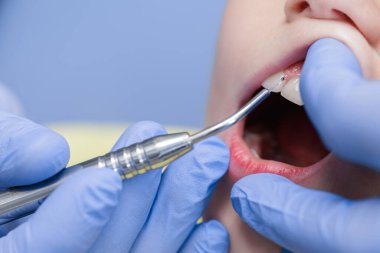 Pediatrik diş bakımı sırasında kesici diş yanında gingiva tedavisi yapan diyot lazeri steril ve nazik bir tekniği vurguluyor.