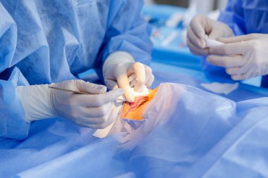 Çağdaş bir klinikte steril perdelerin altında forseps ve gazlı bez kullanarak göz kapağı ensizyonunu tedavi eden Oküloplastik ekip..