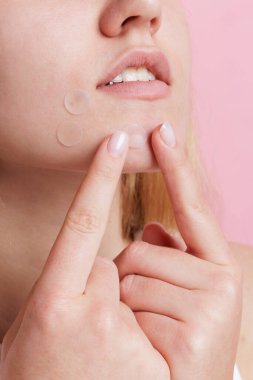 Çene ve yanak beneklerine şeffaf sivilce bantları yapıştıran genç kızın yakın plan alt yüzü ve yumuşak yüz bakımı.