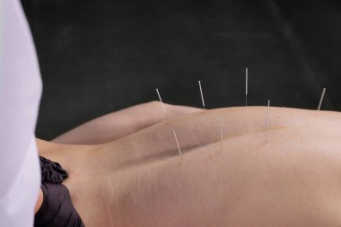 Kuru iğne seansı sırasında hastalara takılan akupunktur iğnelerini kapatın. Klinik web siteleri, sağlık pankartları, sağlık içeriği ve eğitim materyalleri için elverişli.