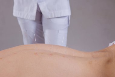 Klinik seans sırasında sırtından kuru iğneli akupunktur alan bir hastanın yakın çekimi. Klinik web siteleri, sağlık sancakları, sağlık eğitimi ve mesleki eğitim içeriği için uygundur.