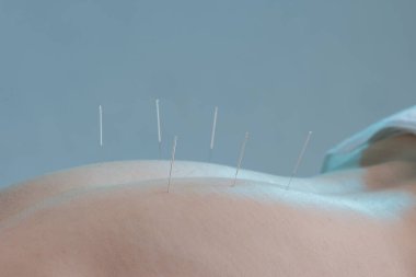 Stüdyo ortamında kuru iğne terapisi sırasında hastalara takılan akupunktur iğnelerine yakından bakın. Tıbbi web siteleri, sağlık reklamları, sağlık blogları ve eğitim materyalleri için ideal.