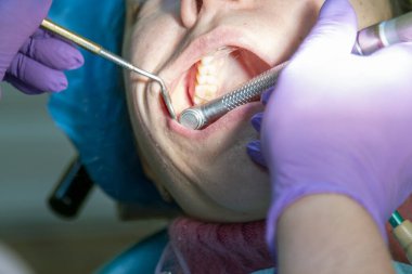 Erkek dişçiler genç bayan hasta üzerinde çalışıyor. Dişçi muayenehanesi. Dişçide sandalyede oturan gerçek bir kadın. Kapat. ses tonlu