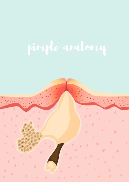 Anatomical structure of pimple — Stock Vector