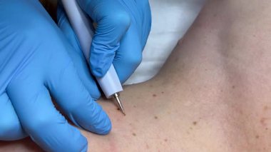 Ameliyat konsepti. Papillomas ameliyatı. Kapatın. Doktor, cerrahi prosedürdeki beni, erkek vücudundaki tıbbi aletler ve ekipmanlarla yakarak çıkarıyor. Yüksek kalite 4k görüntü