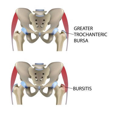 Hip bursitis, vector medical illustration vector clipart