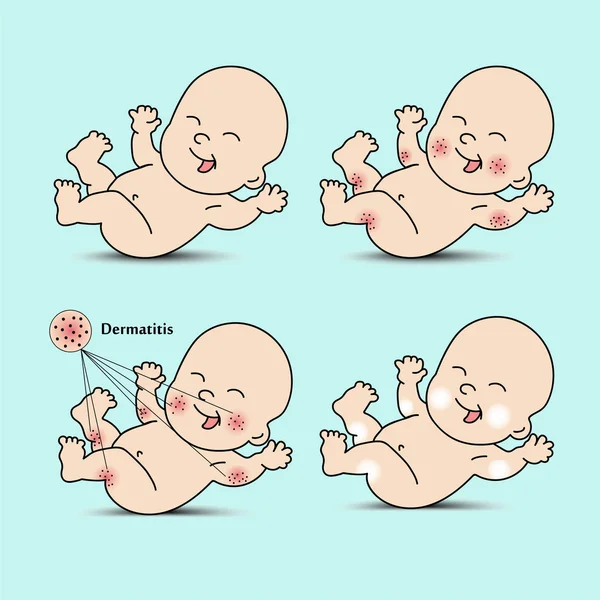 Set dermatitis bebé — Vector de stock