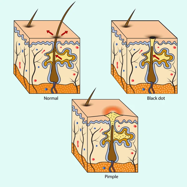 Erupciones cutáneas de anatomía — Archivo Imágenes Vectoriales