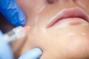 kadın Hyaluronan enjeksiyon