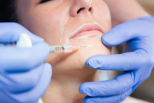 Injecteren van hyaluronzuur — Stockfoto