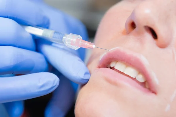 Ácido hialurónico en el labio superior — Foto de Stock