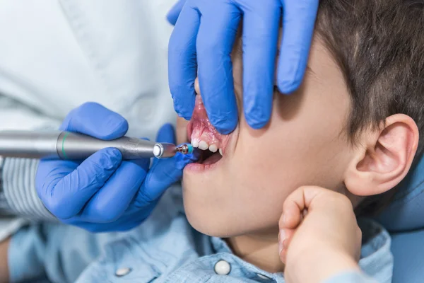 Het verwijderen van tandheelkundige Calculus naar jongetje — Stockfoto