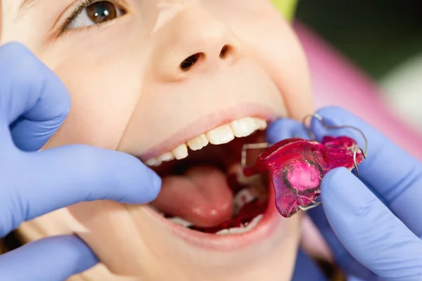 Menina chegando aparelho dentário — Fotografia de Stock