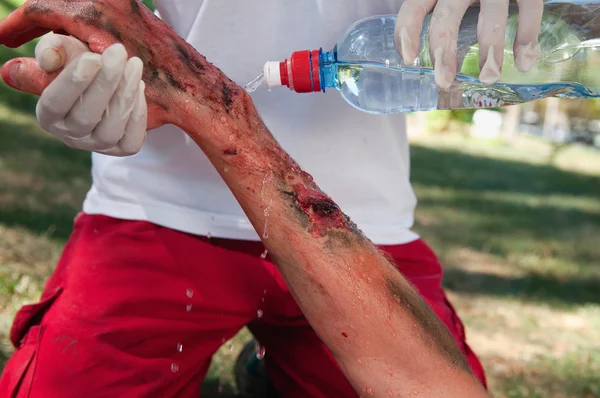 Paramedic treating a victim with third degree burns — Stock Photo, Image