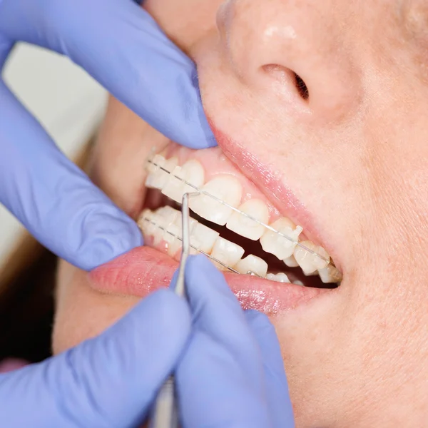 Tightening invisible ceramic braces — Stock Photo, Image