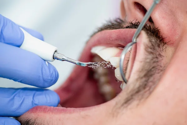 Tratamiento del cálculo dental — Foto de Stock