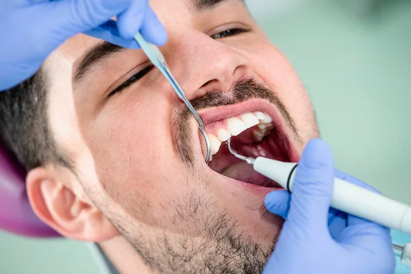 Male patient getting Plaque removal — Stock Photo, Image