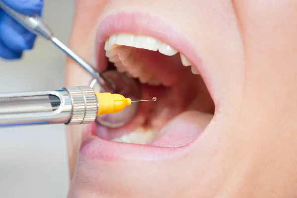 Aplicação de anestesia dentária — Fotografia de Stock